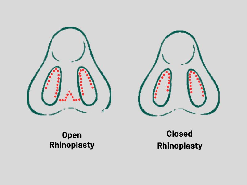 open-and-closed-rhinoplasty techniques in istanbul